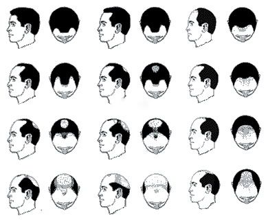 Pattern Baldness on Male Pattern Baldness     Causes Of And Treatments   Cool Men S