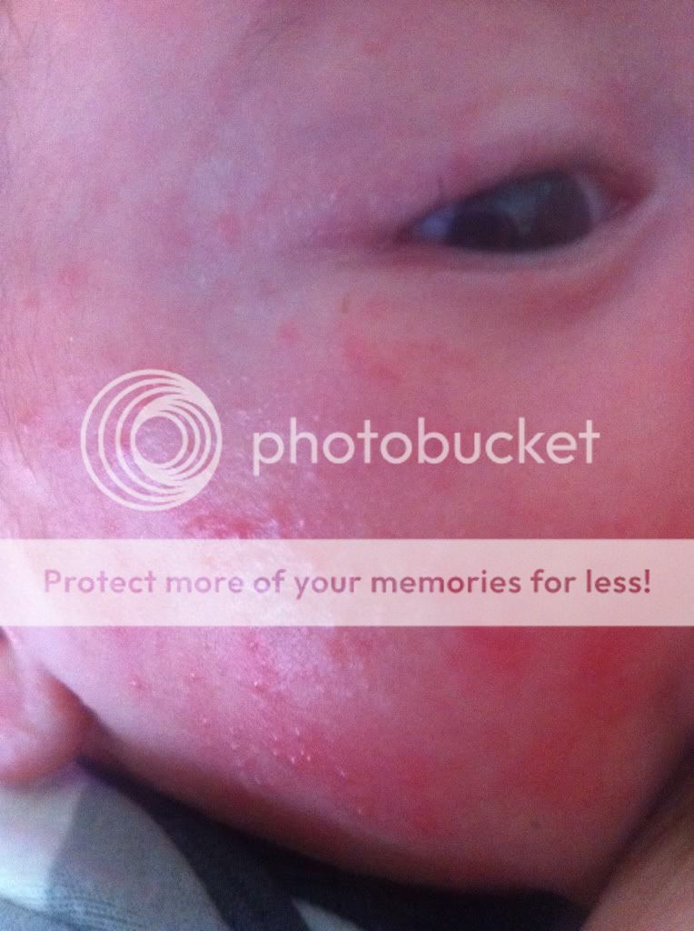 Baby Acne Or Allergic Reaction Pic Included Babycenter